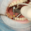 Top 6 Benefits of Choosing Full Dental Implants for Your Smile